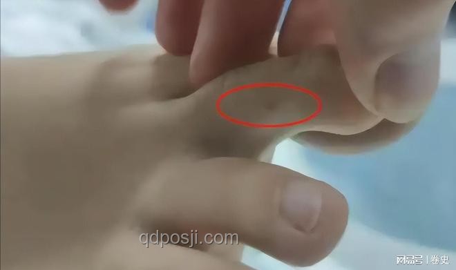 三亚女子被咬身亡救治案例研究：未提蛇咬与救治细节